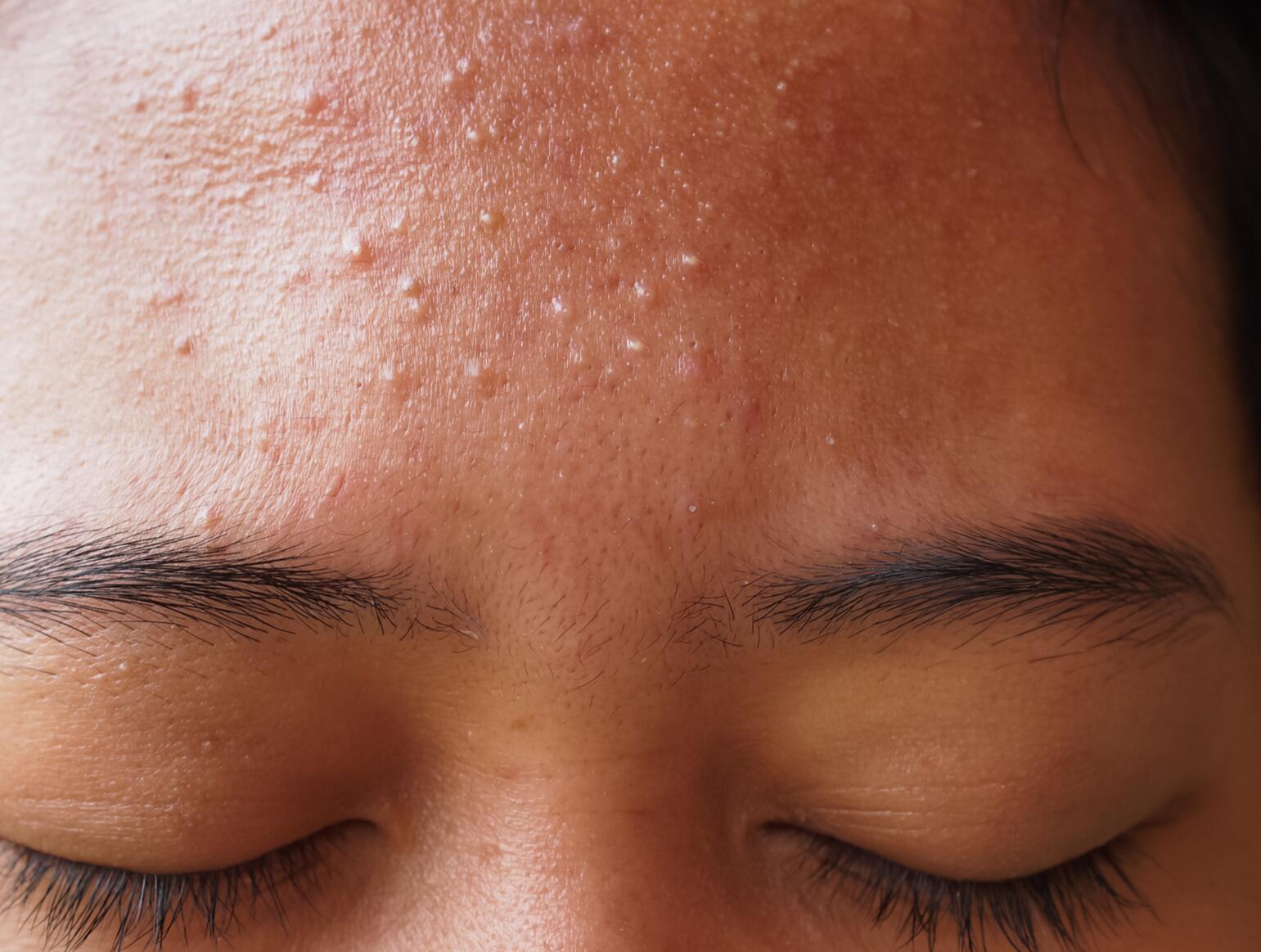 whitehead on the face